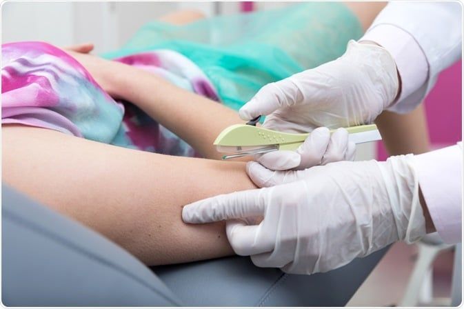 implante contraceptivo Implanon pelo SUS